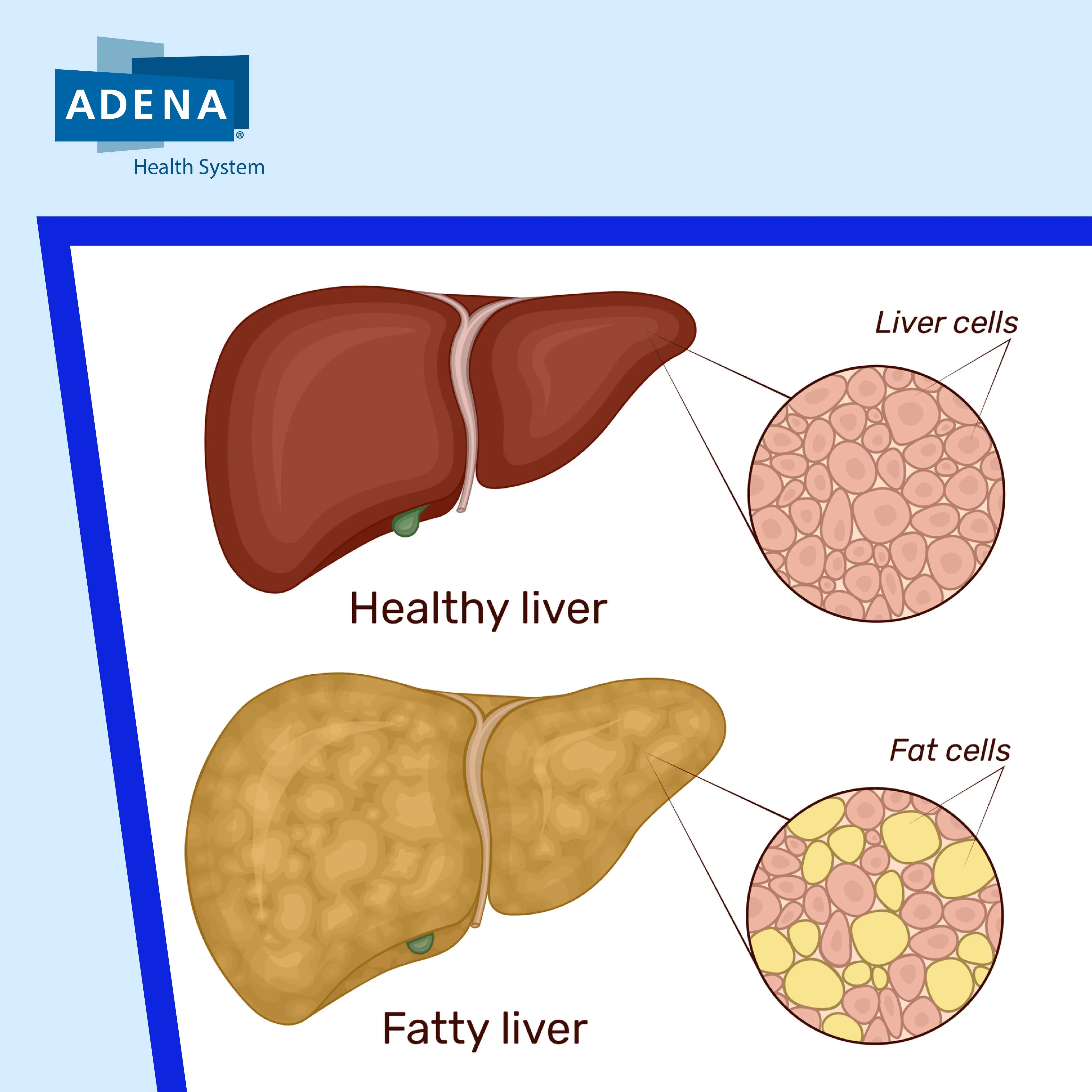 Fatty Liver Disease